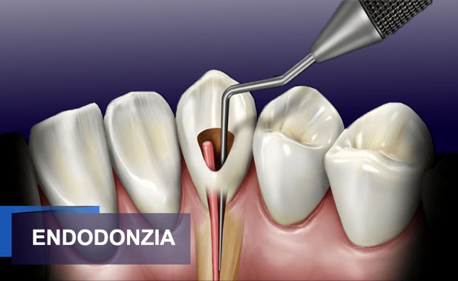 Endodonzia